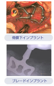 骨膜下インプラント／ブレードインプラントの写真