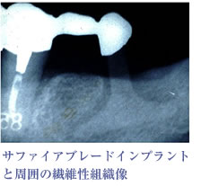 サファイアブレードインプラント と周囲の繊維性組織像