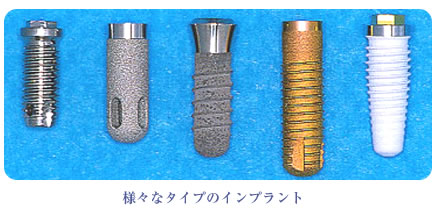 様々なタイプのインプラント